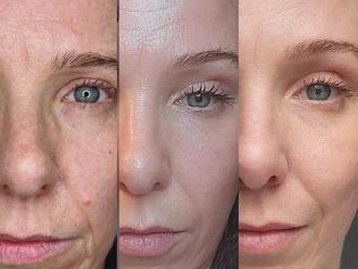 Rejuvenecimiento facial antes y después - 879444
