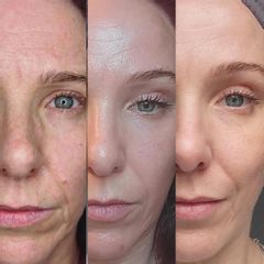 Rejuvenecimiento facial
