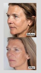Rejuvenecimiento facial