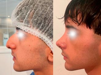 Rinoplastia antes y después - 880896