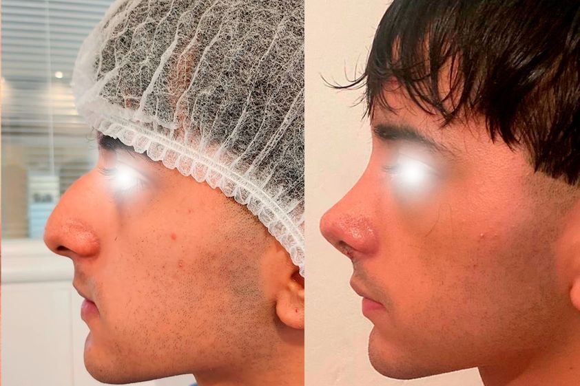 Rinoplastia antes y después - 880896
