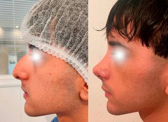 Rinoplastía - Dr. Juan Pablo Oliver