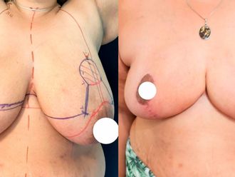 Mastopexia antes y después - 880897