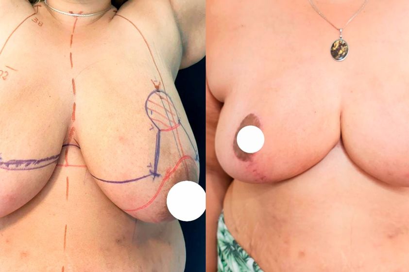 Mastopexia antes y después - 880897