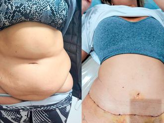 Dermolipectomía antes y después - 880899