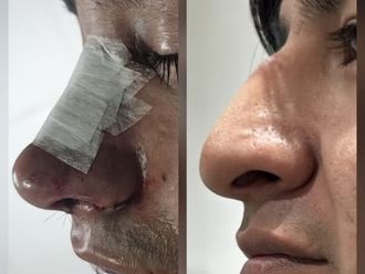 Rinoplastia antes y después - 881164