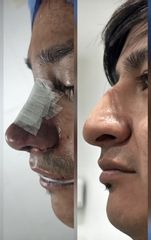 Rinoplastia - Dr. Juan Pablo Oliver