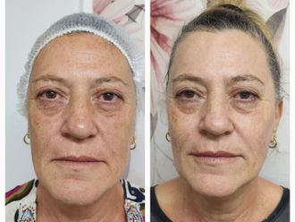 Rejuvenecimiento facial antes y después - 868008