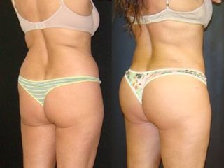 Lipo relleno glúteo