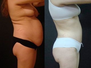 Lipoabdominoplastia
