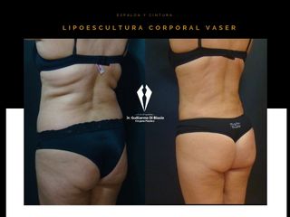 Lipoescultura corporal VASER
