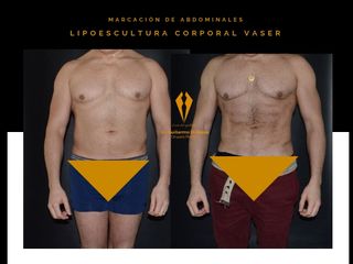 Lipoescultura VASER con marcación de abdominales.