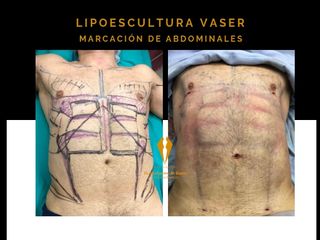 Lipoescultura corporal con VASER en hombres