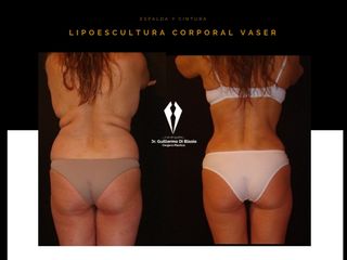 Lipoescultura corporal con tecnología VASER