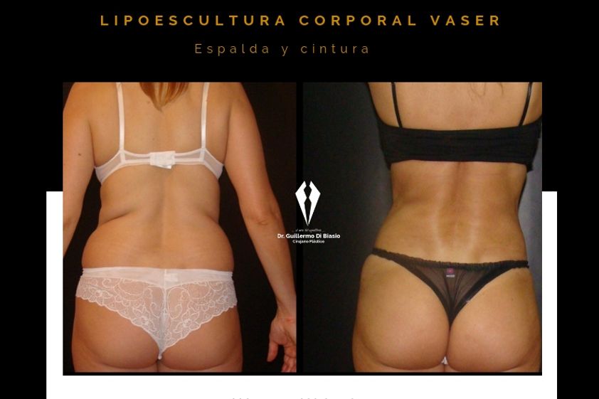 Liposucción antes y después - 633633