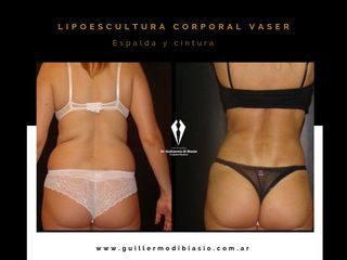 Lipo espalda y cintura
