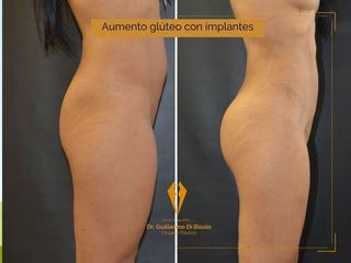 Aumento glúteo con implantes