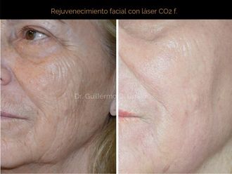 Rejuvenecimiento facial - 638562