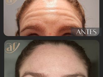 Botox antes y después - 868913