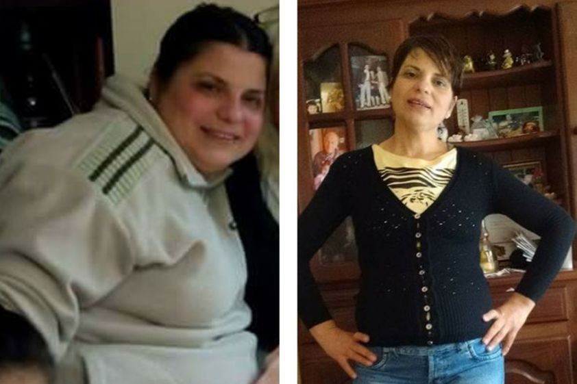Bypass gástrico antes y después - 592687