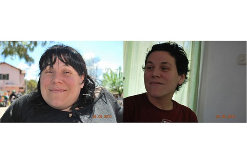 Bypass gástrico antes y después - 592708