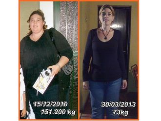 Bypass gástrico antes y después - 592714