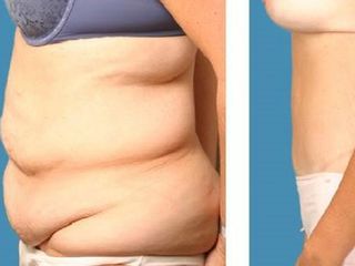 Antes y despues de cirugía reparadora postbariátrica