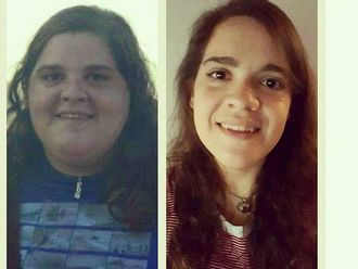 Bypass gástrico antes y después - 597921