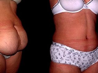 Antes y despues de Reconstrucción estética Post-Bariátrica