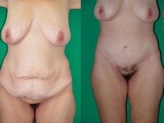 Antes y despues de Reconstrucción estética Post-Bariátrica