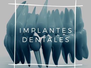 Implantes_Dentales_Nueva_Córdoba_Consultorio_Odontológico_en Nueva_Córdoba_de_Sebastián_Massouh_Od
