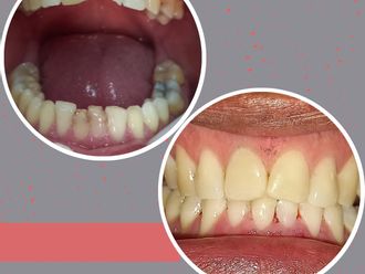 Carillas dentales - 843668