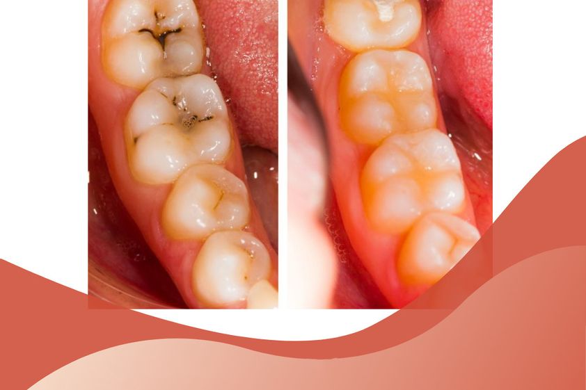 Periodoncia antes y después - 843669