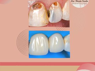 Carillas dentales - 843671