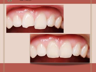 Carillas dentales - 843673