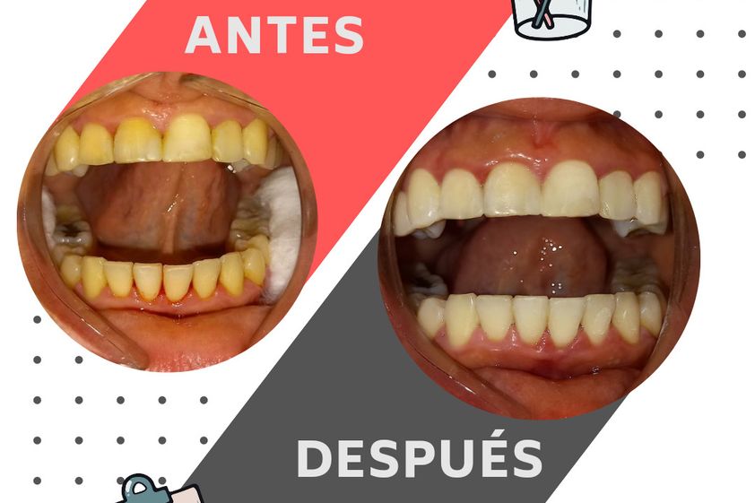 Blanqueamiento dental antes y después - 843674