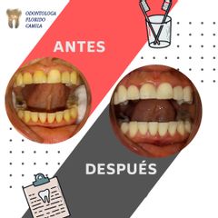 Blanqueamiento dental - Dra. Camila Florido