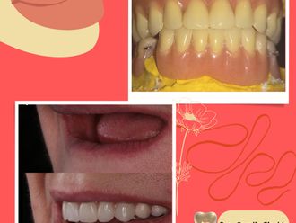 Prótesis dentales - 843675