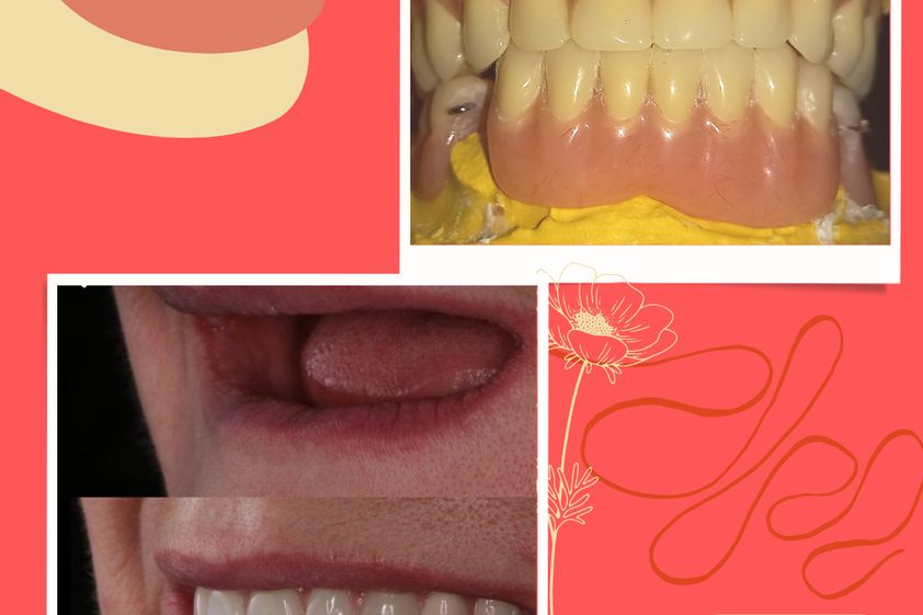 Prótesis dentales antes y después - 843675