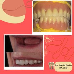 Prótesis dentales - Dra. Camila Florido