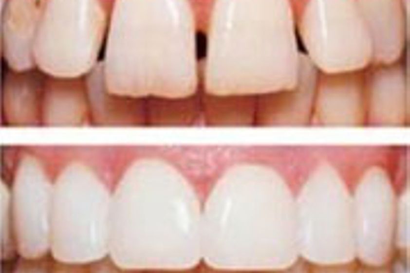 Carillas dentales antes y después - 282779