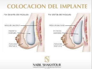 Implantes de mamas