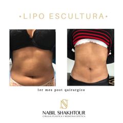 Lipoescultura
