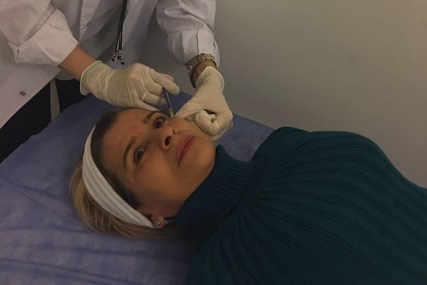 Botox antes y después - 614165