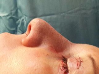 Rinoplastia