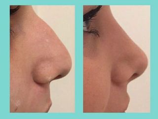 Rinoplastia