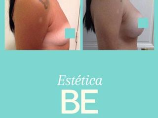 Antes y Después