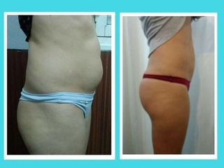Antes y Después Liposucción