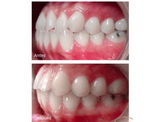 antes y despues 1 ortodoncia san juan