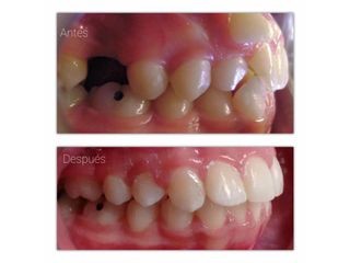 Antes y después - Ortodoncia san juan